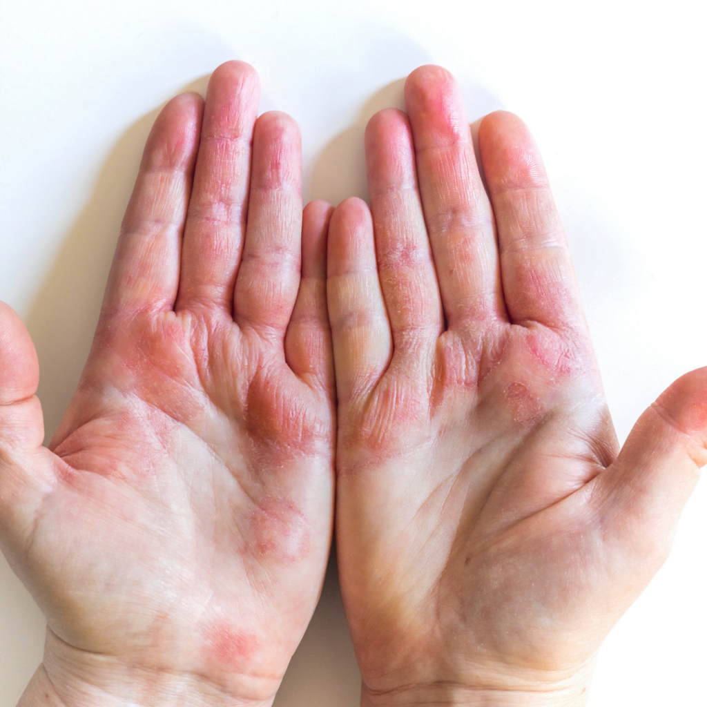 very dry and red-spotted hands due to dryness.